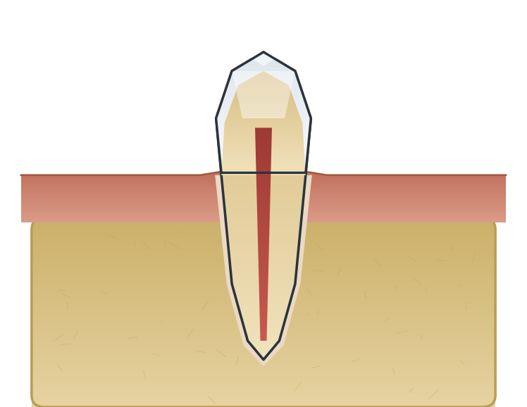 Illustration: Tooth erosion