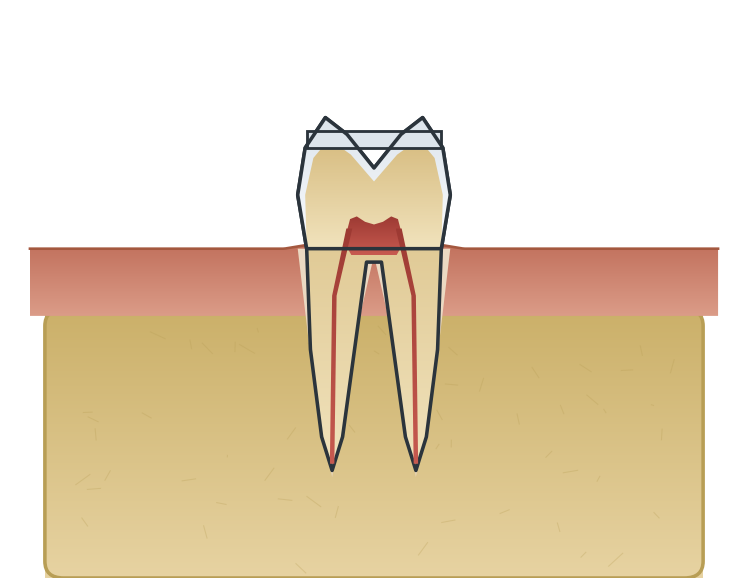 Illustration: Tooth wear