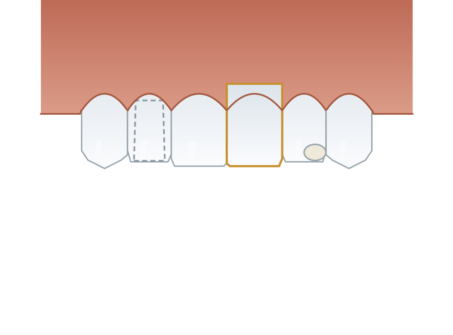 Illustration: Veneers, crowns or bonding?