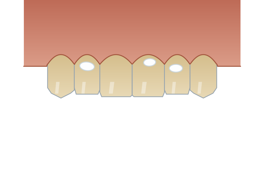 Illustration: White spots on teeth