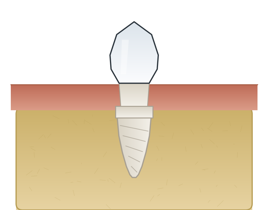 Illustration: Zirconia implants